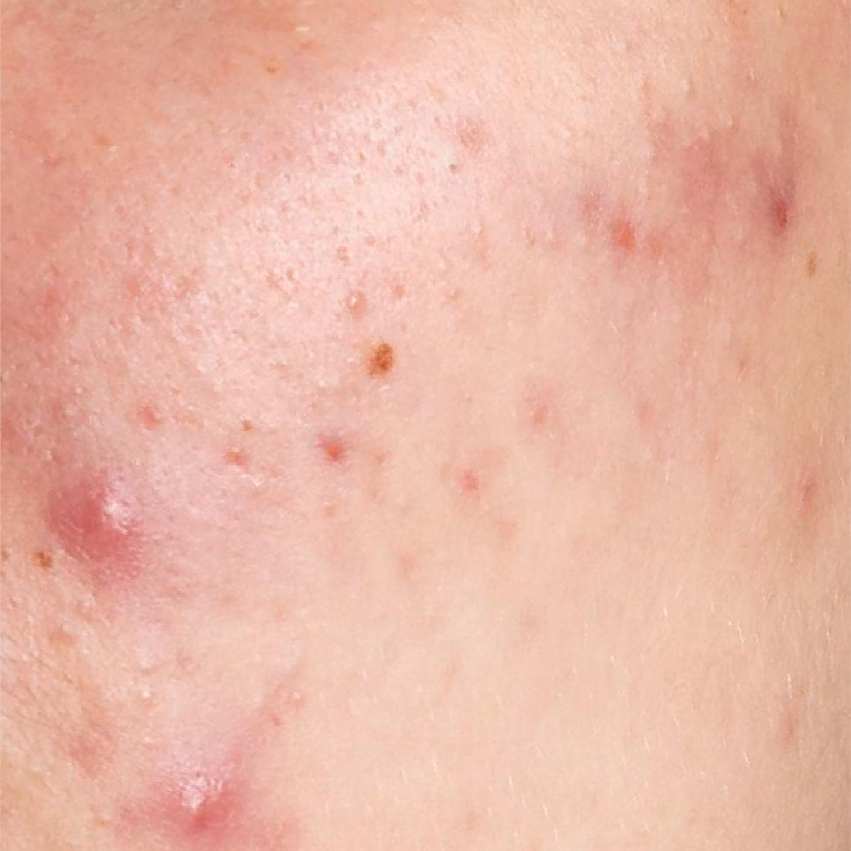 Acne Prone Skin